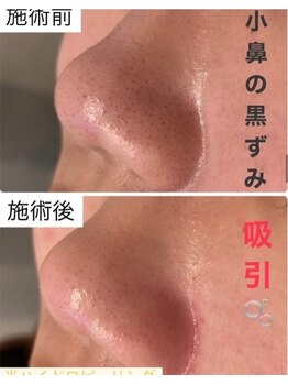 アリュール(ALLURE)/光ハイドロピーリングの施術効果