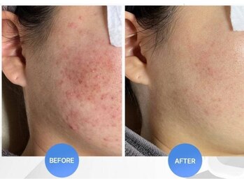 ビーシェイプ 君津(B-Shape)/症例【ハーブピーリング】