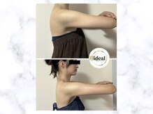 アイディール(ideal)/脂肪減少10ミリコース