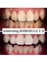シロハ(SHIROHA)/セルフホワイトニング/天王寺