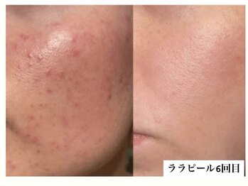 ビジュー(BIJOU)/プラピール