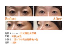 シルエラバレ(CiruelaValle)/Before After