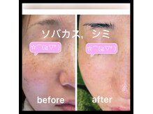 ココスタイルビューティー(COCOSTYLE beauty)の雰囲気（シミケアし放題にてすっかり軽減です）