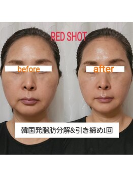 セレブリティ(Celebrity)/RED SHOT 引き締め 弾力