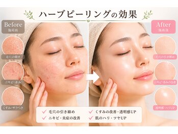 ボヌールウメダ(Bonheur UMEDA)の写真/◆ツルッと弾ける毛穴レス肌へ◆ハーブピーリングで肌質改善！加工いらずの美肌を目指す方へ♪