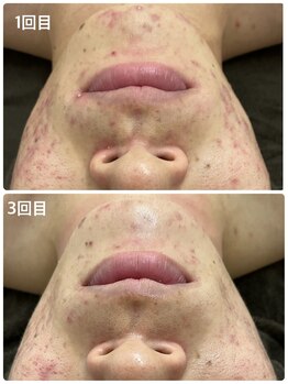 リル(Lil)/REVIハーブピーリング