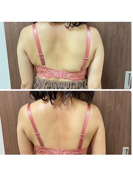 エミニナル(EMININAL)/【バストケア】ビフォーアフター