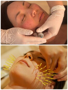 皇漢堂鍼灸療院/当店は2種類の美容鍼があります