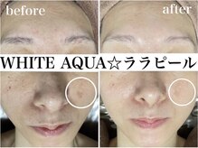 ホワイトアクア 錦糸町店(WHITE AQUA)/ララピール/毛穴/東京/錦糸町