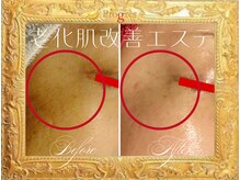 エステティックルームプログレス(Esthetic Room Progres)の雰囲気（50代女性　生ヒト幹細胞フェイシャル　）