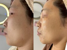 エミュ(emu)/レモンボトルで小顔に