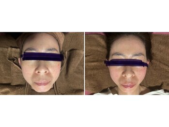 イールーム(eroom)/たるみUp!小顔フェイシャル