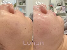 ルノン(Lunon)/毛穴洗浄ハイドロ×ララピール