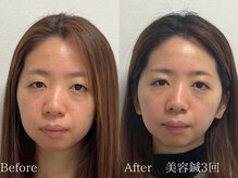 ひじ鍼灸整骨院/小顔鍼Before /After◎