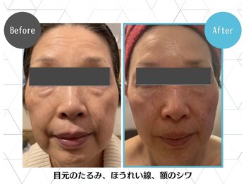 アンプリール(emplir)の写真/「最近老けた？」と言わせない！ほうれい線・たるみを徹底ケア。キュッと引き締まった、若々しいお顔へ