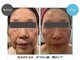 アンプリール(emplir)の写真/「最近老けた？」と言わせない！ほうれい線・たるみを徹底ケア。キュッと引き締まった、若々しいお顔へ