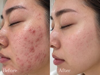 アフター(AFTER)の写真/【肌質改善◇南郷7丁目駅徒歩30秒】自己流のニキビケアでは太刀打ちできなかった凸凹跡や背中ニキビケアに!