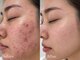 アフター(AFTER)の写真/【肌質改善◇南郷7丁目駅徒歩30秒】自己流のニキビケアでは太刀打ちできなかった凸凹跡や背中ニキビケアに!