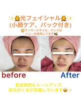チロル(CHIROL)/光フェイシャル小顔ケアパック付