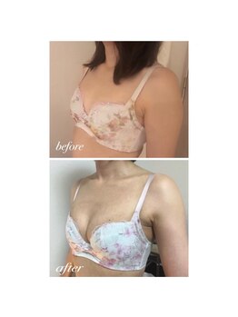 ラポッシュ(La poche)/バストアップ症例写真/産後ケア