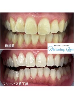 ホワイトニングサロン 熊本店/熊本セルフホワイトニング