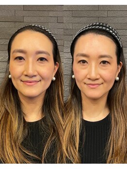 長寿鍼灸院 長寿整骨院/ハリネズミ女優美容鍼効果★