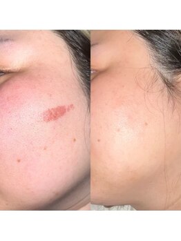 エラ(ella)/30代シミケア・傷跡・色素沈着