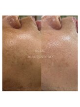 エクラ(eclat)/10回のエステより1回のハーブ