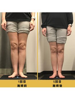 ベル/【40代会員様】O脚矯正の変化