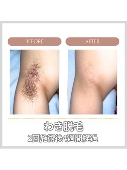 エクレ 今池店(EKURE)/脇脱毛