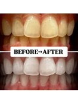 ホワイトニングサロン 宝塚/Before&After美白ホワイトニング