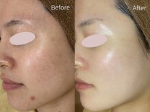 ミーラヤ(MILAYA)/梅田毛穴/梅田リアボーテ