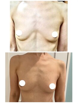 美人バスト 浦和店/【バストアップ★育乳】症例