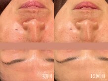 ウォーム(warm)/乾燥/敏感肌/赤み/フェイシャル