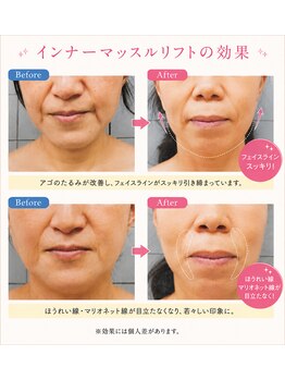 セレブリティ(Celebrity)/エイジング★たるみ改善】
