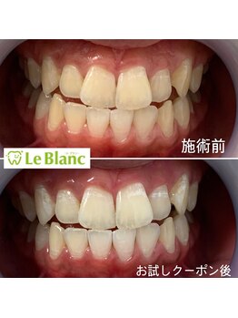 ルブラン 奈良店(Le Blanc)/黄ばみ気になりませんか？