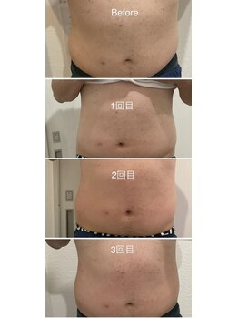 セラス(CERAS)/フォースカッター　お腹30分