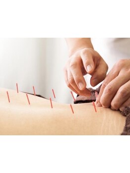 鍼灸施術を受けたい