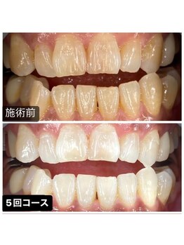 グラスプレイス/プレミアム症例 1