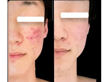 ジーニー(Genie)/マスクを外しても自信を！