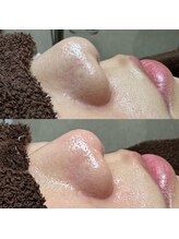 エクラ バイ シャンリィ(eclat by shanLy)/毛穴息してる？