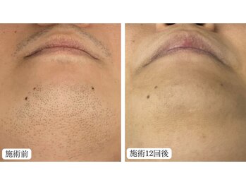 トパーズ 藤枝店(Topaz)/メンズ脱毛 ヒゲ脱毛 藤枝