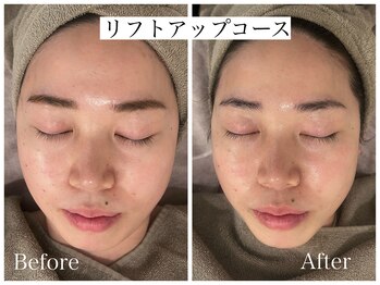 アンベリール(embellir.)/リフトアップコース