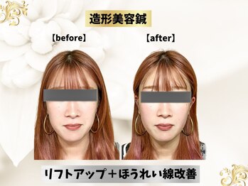 エモシオン トウキョウ(EMOTION TOKYO)/造形美容鍼