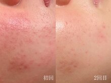 ウォーム(warm)/乾燥/敏感肌/赤み/フェイシャル