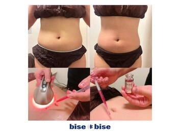 ビズビズ 梅田店(bisebise)の写真/憧れのくびれはコレ！脂肪分解レッドショット＆高周波EMSのトリプルアプローチ！美容医療提携サロンで安心