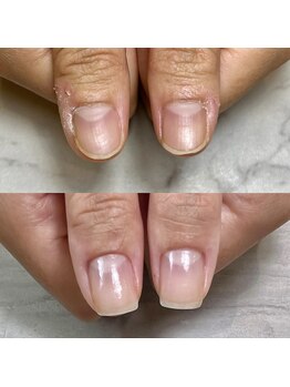 ロイネイル 掛川店(LOI nail)の写真/【5月NEWOPEN】ジェルネイルができない方も自爪のまま縦爪にケア！【3ヶ月コース】で自信が持てる爪先に☆