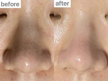 ユイット ルッカ(Huit Lucca)の写真/ざらつきスッキリ【ハイドロフェイシャルで毛穴洗浄】頑固な毛穴汚れや黒ずみをごっそり徹底除去&引き締め!