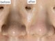 ユイット ルッカ(Huit Lucca)の写真/ざらつきスッキリ【ハイドロフェイシャルで毛穴洗浄】頑固な毛穴汚れや黒ずみをごっそり徹底除去&引き締め!