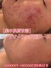 【集中肌改善】ハーブピーリング6回継続チケット特典付き¥77,000→¥60,500